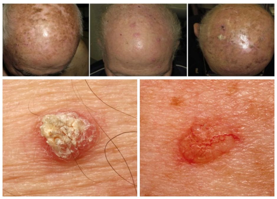 Kurie nekaltai atrodantys odos dariniai gali sukelti vėžį?