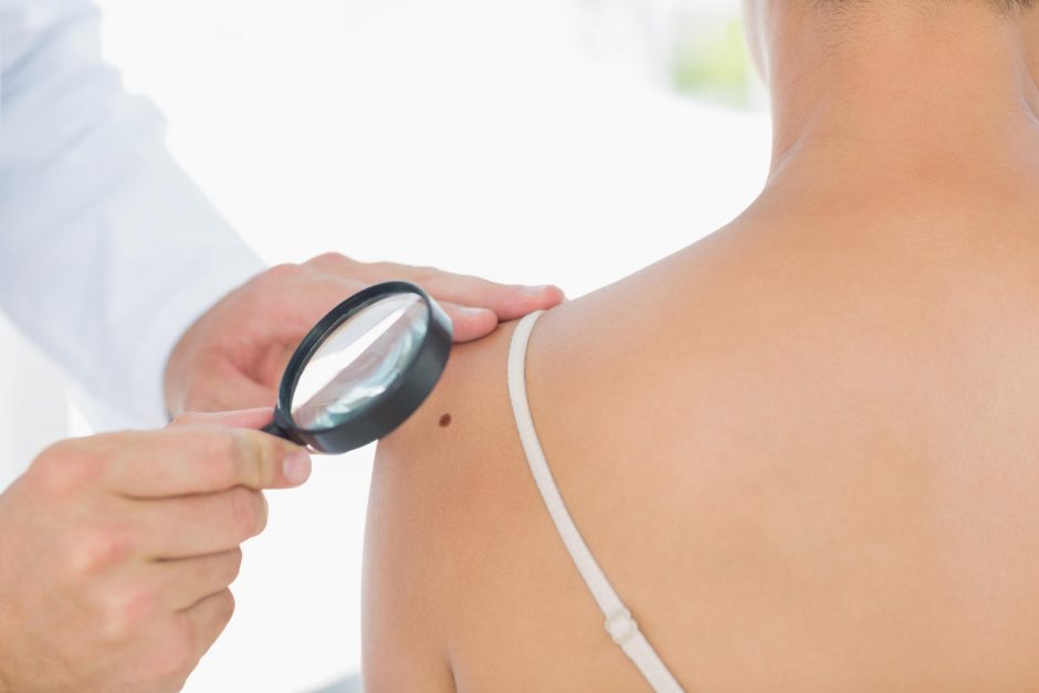 Ankstyva melanomos diagnostika – svarbiausia sėkmingam gydymui