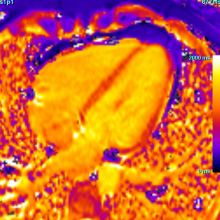 Padeda: širdies MRT svarbus nustatant kardiomiopatiją, išeminę širdies ligą, miokarditą, įgimtas vaikų širdies ydas.