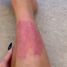 K. Kardashian parodė žaizdotą koją: nepagydoma liga progresuoja
