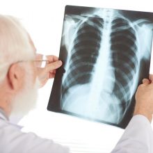 Plinta nauja ir mirtinai pavojinga tuberkuliozės forma: ligonis nejaučia jokių simptomų