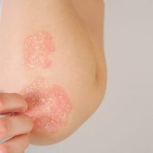 Žvynelinė yra daugiau nei tik odos liga