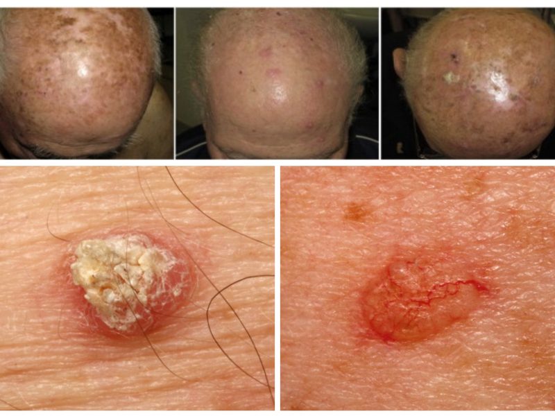 Kurie nekaltai atrodantys odos dariniai gali sukelti vėžį?