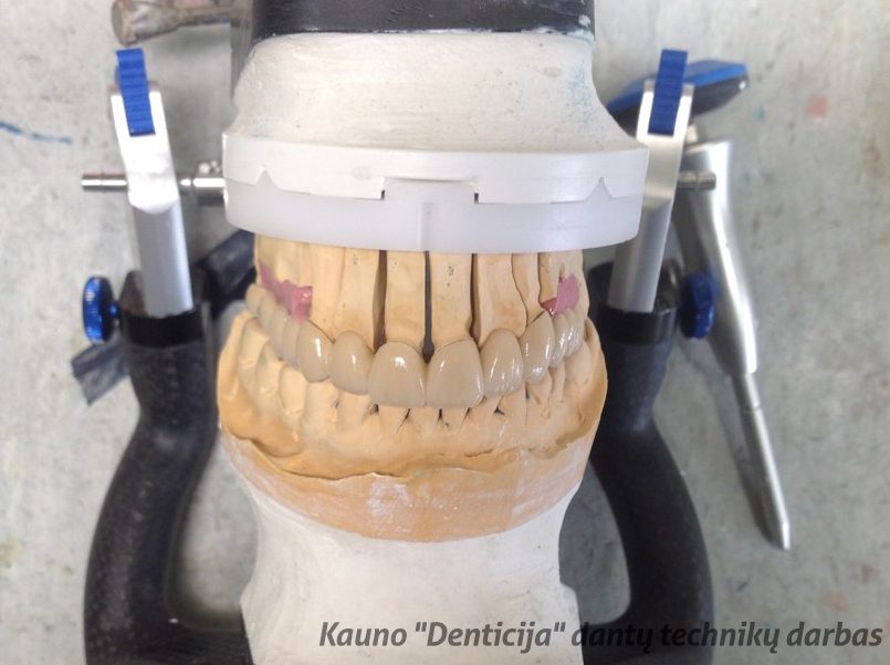 Dantų protezavimas: cirkonis ar metalas – ką pasirinkti?