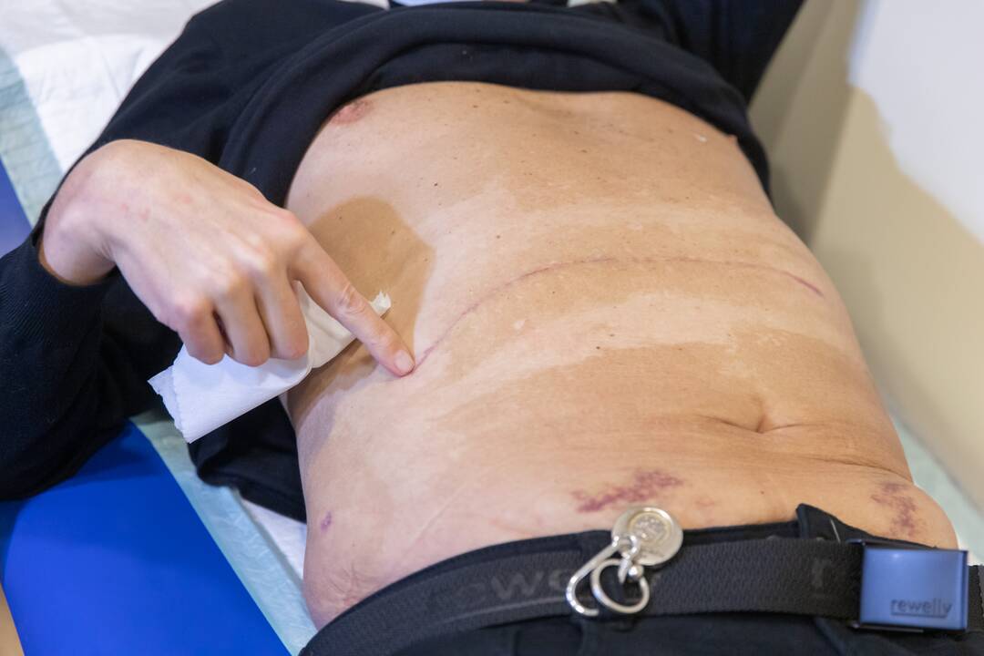 Kauno klinikų medikai – apie organų transplantacijas