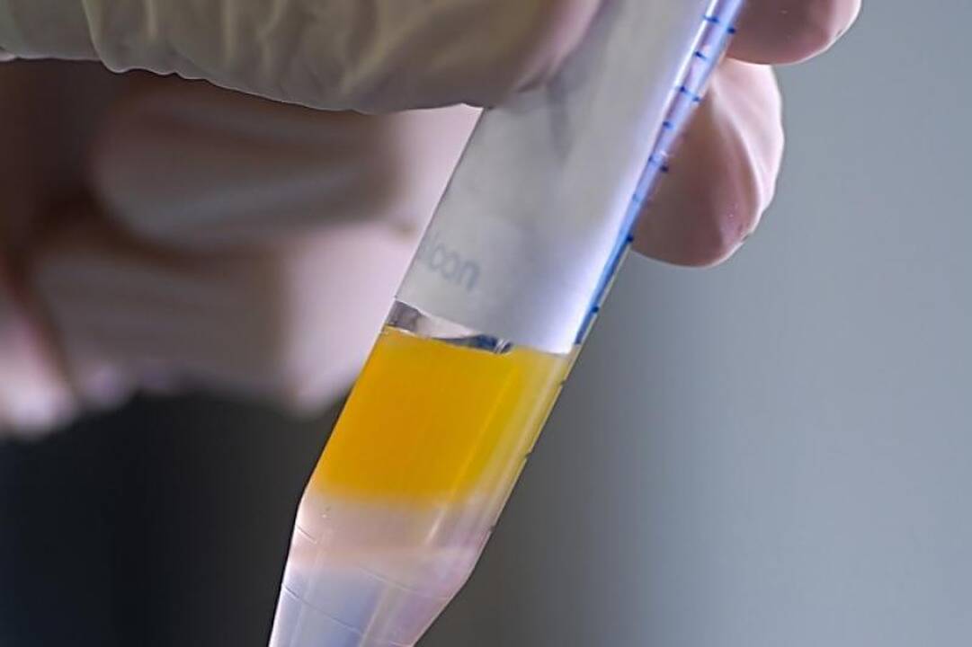 Įspėjimas pasauliui: prancūzų spermoje 30 proc. sumažėjo spermatozoidų