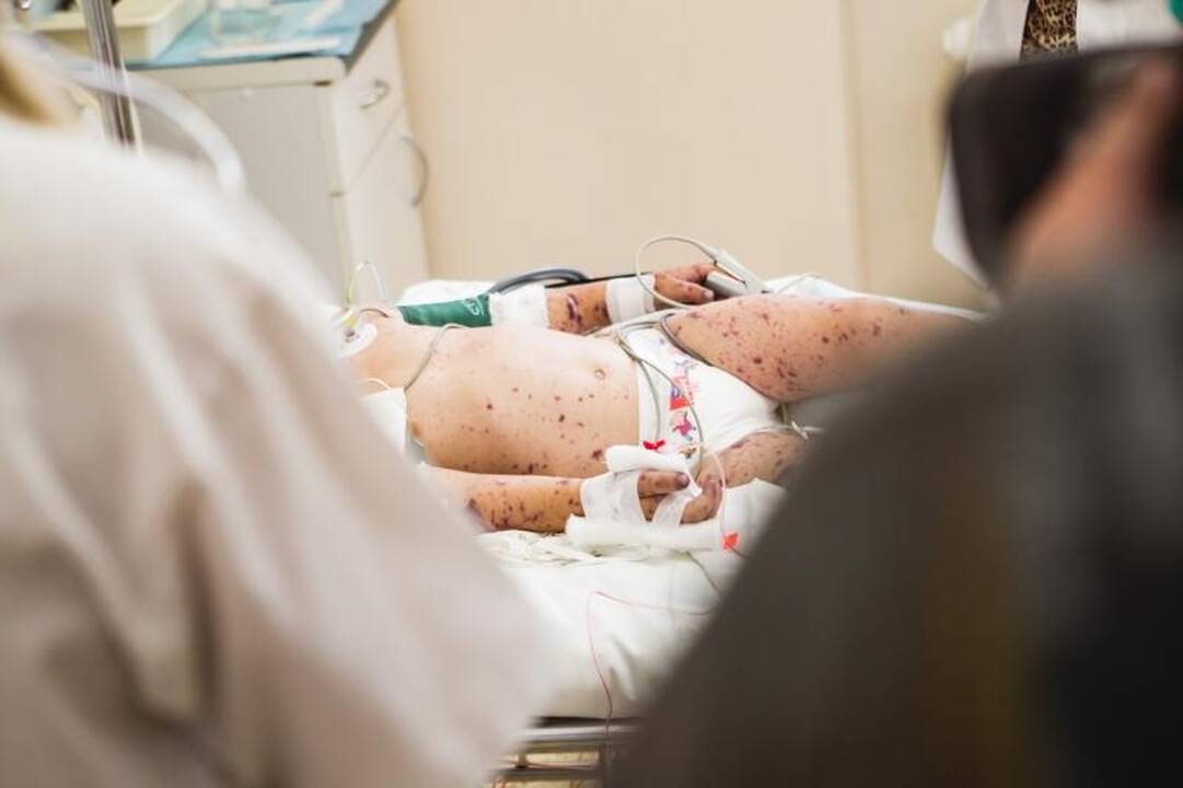 Meningokokinė infekcija pakirto tris vaikus, vienas mirė 