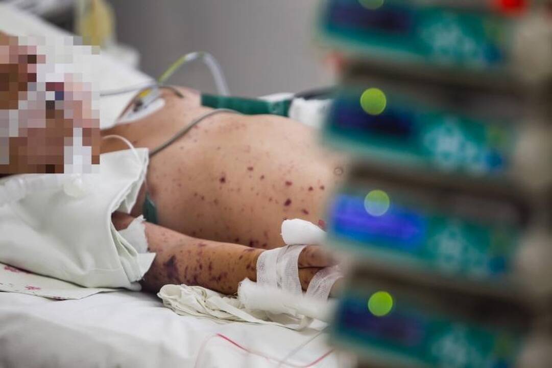 Meningokokinė infekcija pakirto tris vaikus, vienas mirė 
