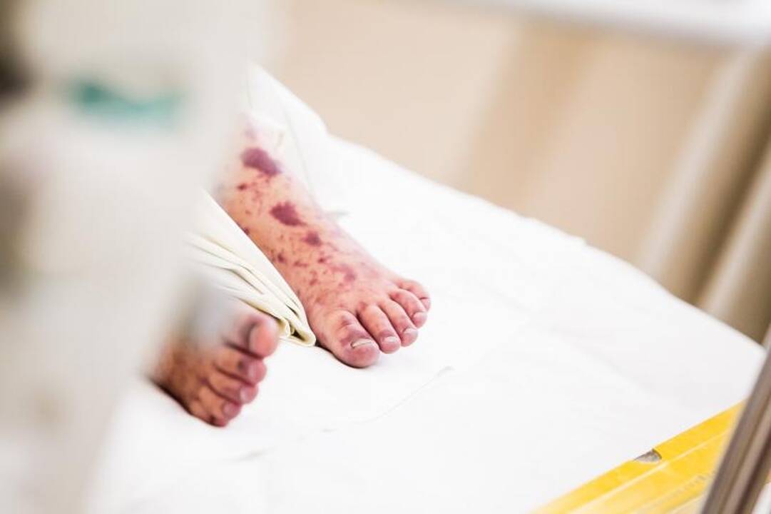 Meningokokinė infekcija pakirto tris vaikus, vienas mirė 