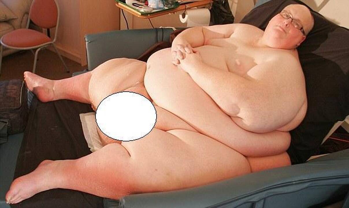 Storiausiam vyrui, svėrusiam 445 kg, reikia pašalinti „odos perteklių“