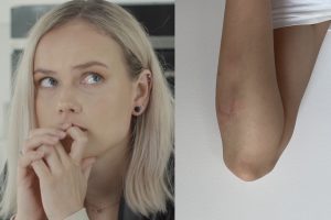 Prie ežero užpulta aktorė D. Kundrotaitė: vyras spyrė į galvą, nebuvo kur dėtis, šokau į vandenį