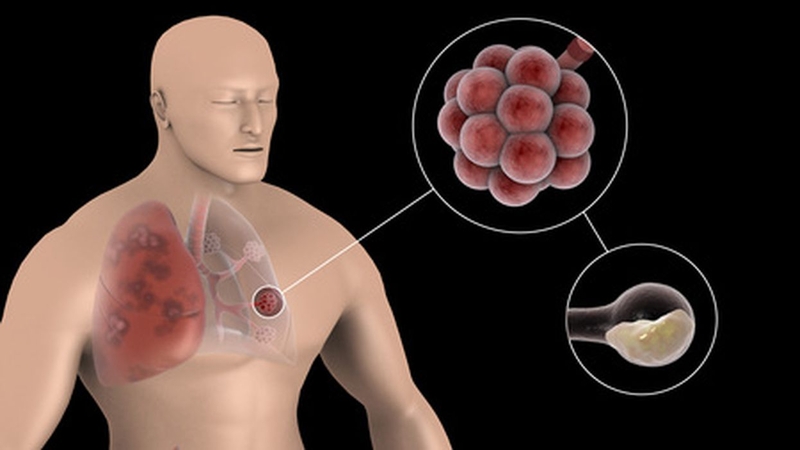 Pernai pneumokokinės infekcijos atvejų Kaune – ženkliai mažiau