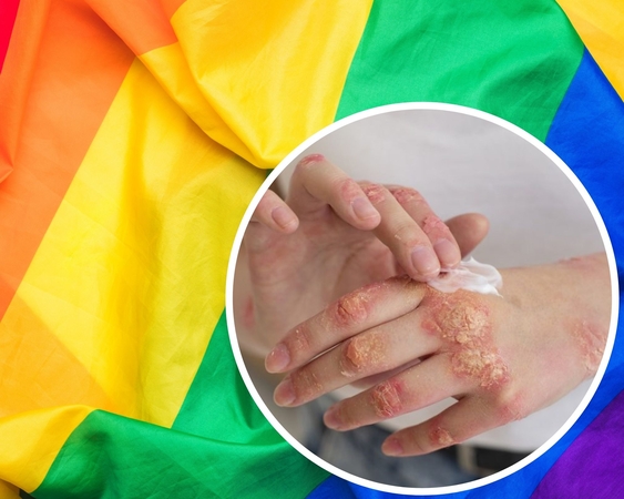Prašo nesieti LGBT su beždžionių raupais: tai stiprina homofobiškus stereotipus
