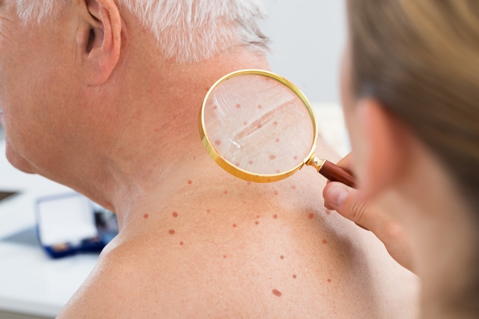 Melanoma susirgęs Stanislovas: visą gyvenimą deginausi kaip šokoladas