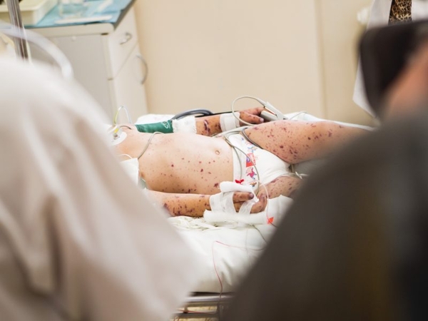 ULAC: skiepų nuo meningokokinės infekcijos apimtys išaugo per 30 kartų