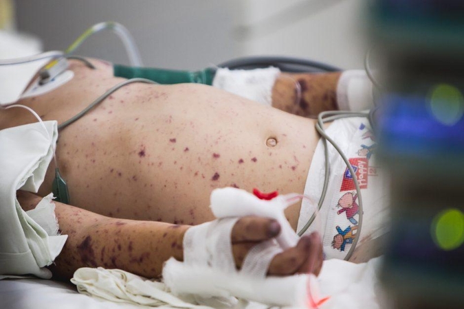 Apklausa: dauguma tėvų neatpažintų meningokokinės infekcijos simptomų
