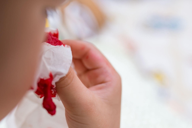 Kraujavimas iš nosies vasarą itin dažnas: kaip atskirti tikrą pavojų širdžiai?
