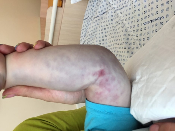 Ligoninėse – vaikai, kuriems įkando gyvatės: ką daryti ir ko – ne