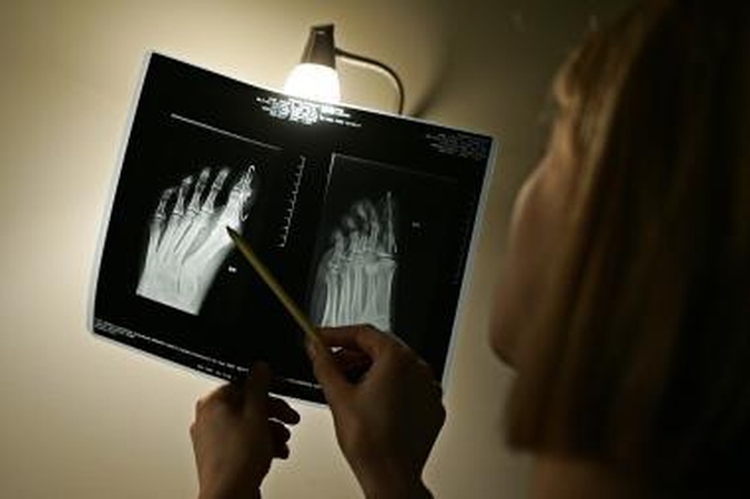 Stebuklingi milteliai ataugins suluošintas galūnes?