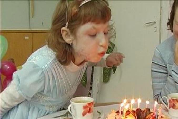 37 procentus kūno per gaisrą nudegusi Laurutė svajoja, kad kas išgydytų randus