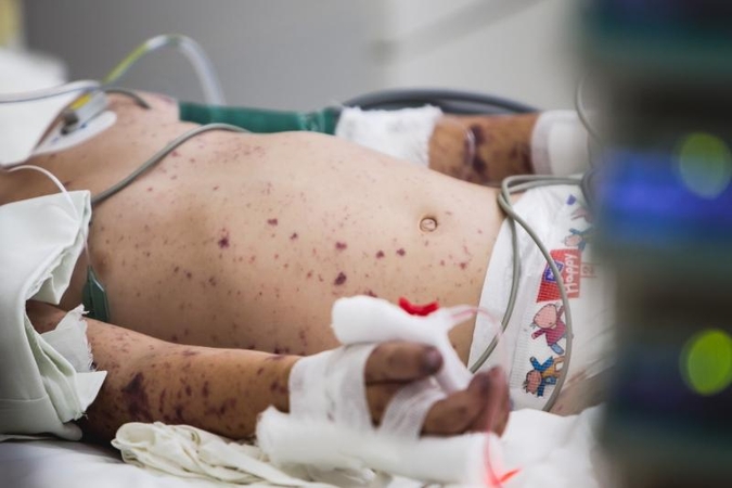 Su grėsminga infekcija kovojančio trimečio būklė gerėja