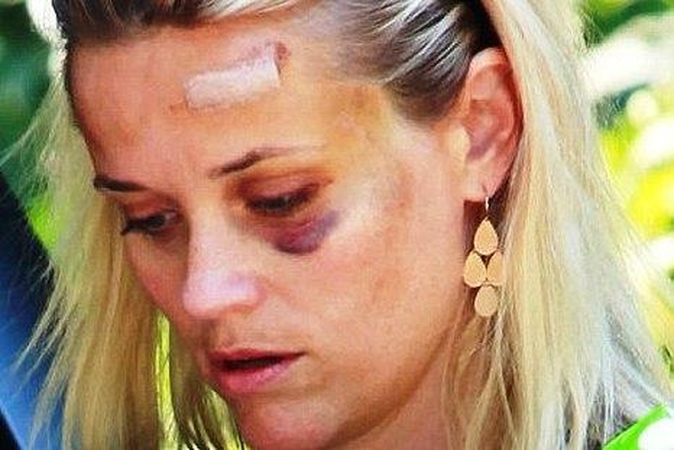 R.Witherspoon parodė avarijoje „įtaisytą“ mėlynę po akimi